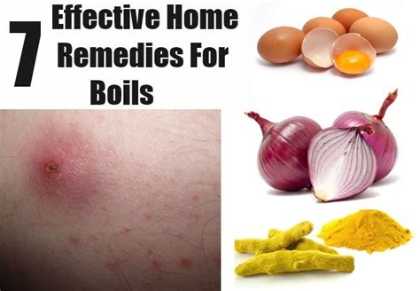 7 Effective Home Remedies For Boils Natural Remedies For Boils, Home ...