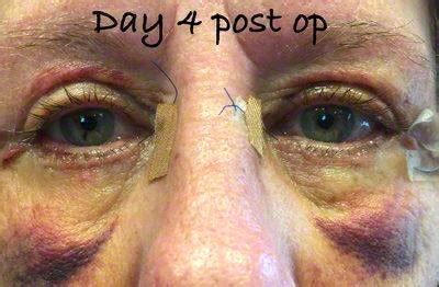 Recovery After Eyelid Surgery » Eyelid Surgery: Cost, Photos, Rewiews, Q&A