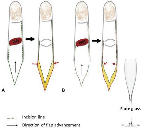 Neurovascular Advancement Flap to Release Flexion Contracture of the ...