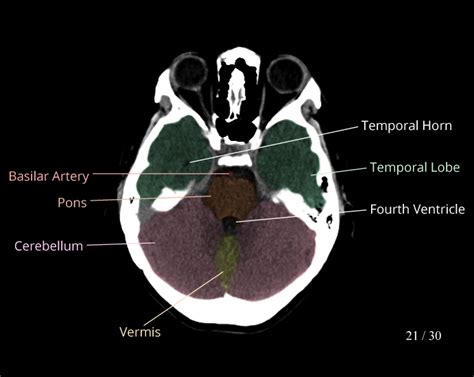 miércoles Odio lanzar cranial ct scan anatomy pedir disculpas vía máscara