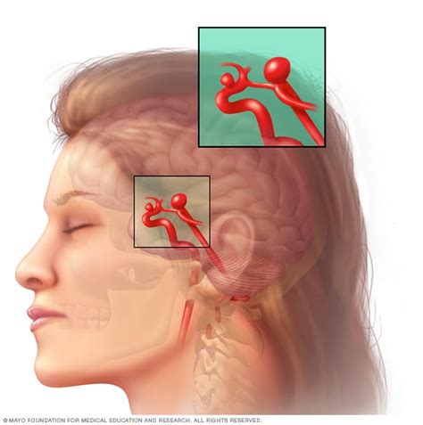 Brain aneurysm - Symptoms and causes - Mayo Clinic