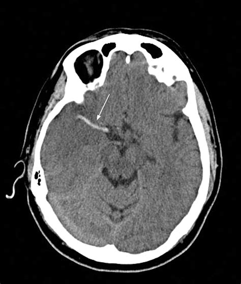 Evolving hyperdense middle cerebral artery sign | Journal of Neurology ...