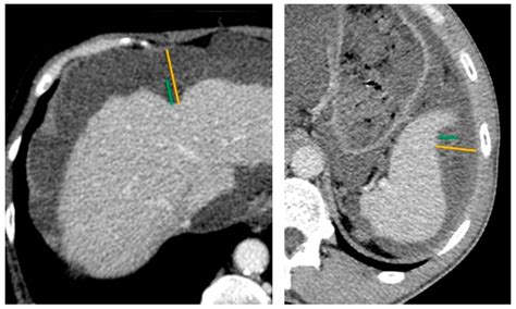 Cancers | Free Full-Text | Scalloping of the Liver and Spleen on ...