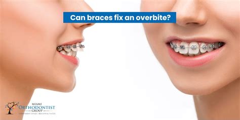 Can braces fix an overbite? - Miami Orthodontist Group