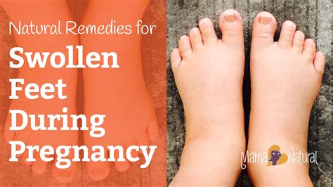 Swollen Feet During Pregnancy: Natural Remedies