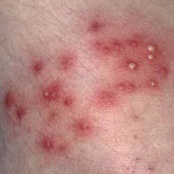 golden staph infection - Google Search | Skin infection, Staph ...