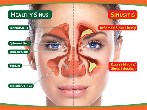 Sinus Infection (Sinusitis): Causes, Symptoms Treatment | atelier-yuwa ...