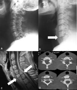 Fracture Dislocation C6 to C7: Importance of Adequate Radiographs - The ...