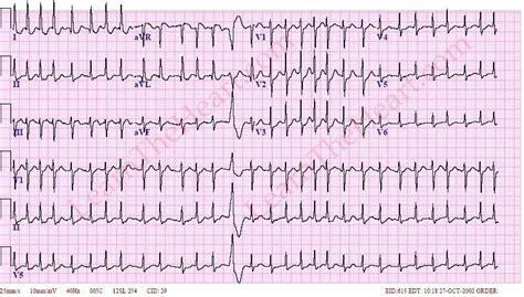 Atrial Fibrillation with Rapid Ventricular Rate ECG (Example 5) | Learn ...