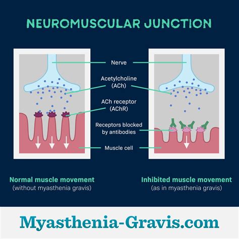 Causes of Myasthenia Gravis