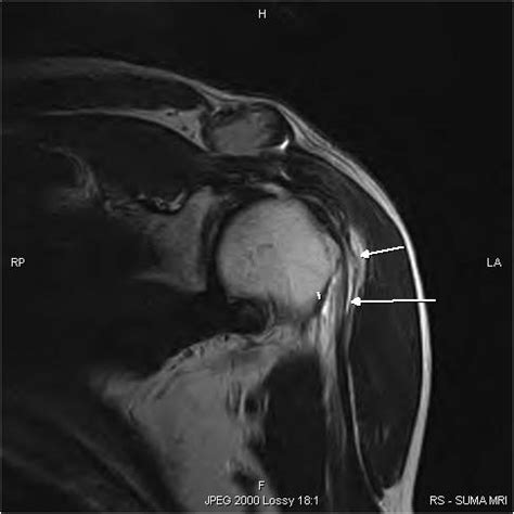 Long head of Biceps Rupture-MRI - Sumer's Radiology Blog