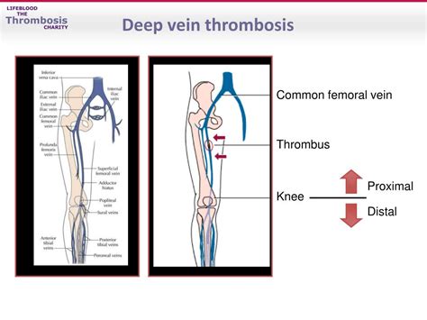 PPT - Venous thromboembolism – Treatment and secondary prevention ...