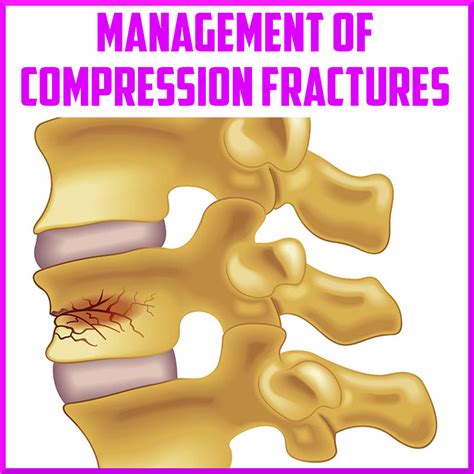 Administration of vertebral compression fractures - My Blog