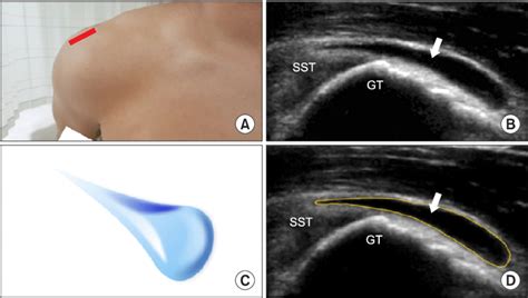 Subdeltoid Bursitis Mri