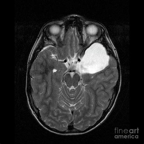 Arachnoid Cyst Photograph by Simon Fraser/science Photo Library