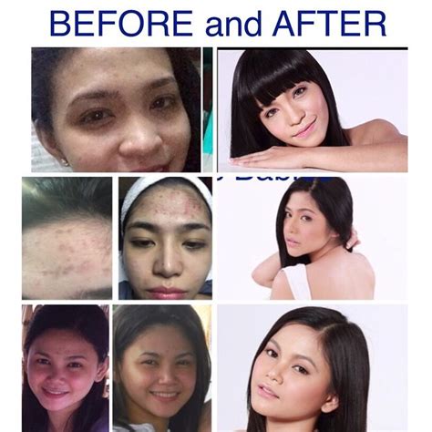 Astonishing Transformations After Using Glutathione