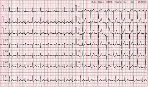 Electrocardiogram (ECG) showing sinus tachycardia with abnormal Q waves ...