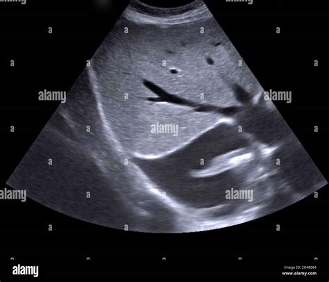 Pleural effusion, ultrasound scan Stock Photo - Alamy