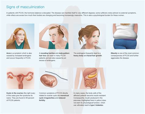 Help for women with polycystic ovary syndrome – research magazine