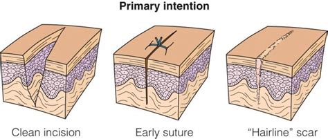 Get Me Into Vet School – rn-students-unite: First intention wound edges...