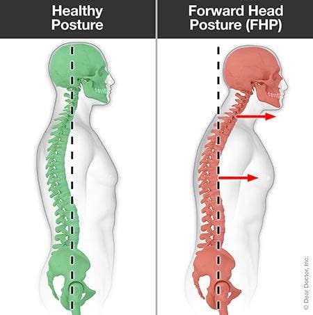 Posture Problems | Chiropractor In Calumet City, IL | ES3 Fitness Rehab