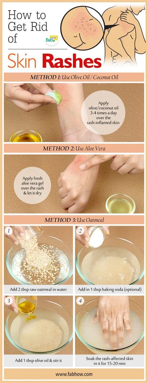 27+ How To Get Rid Of Heat Rash On Hands struggling to ]