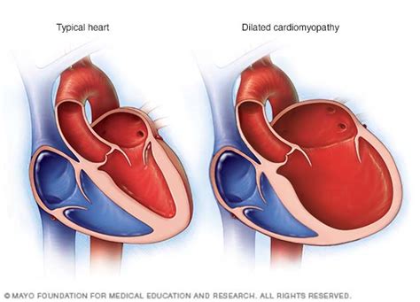 Dilated cardiomyopathy - Mayo Clinic