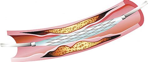 When do you need a heart stent? - Harvard Health