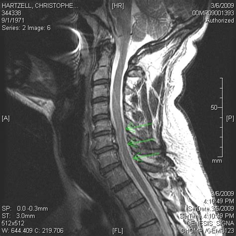 Abnormal Neck Mri Pictures to Pin on Pinterest - PinsDaddy