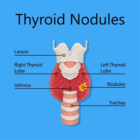 Thyroid Nodule Radiofrequency Ablation | FVC