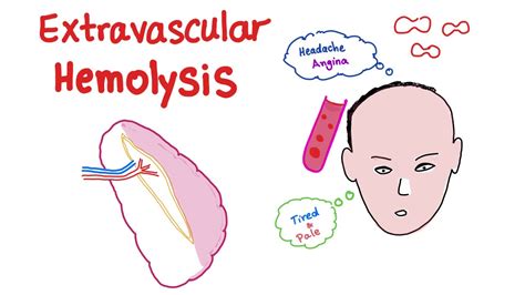 Extravascular Hemolysis - YouTube