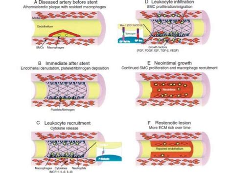 IN STENT RESTENOSIS