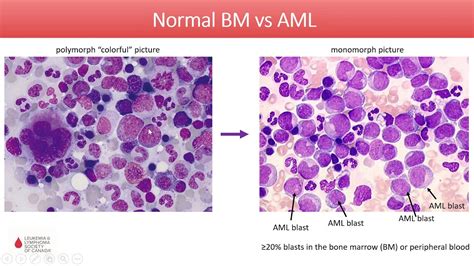 Acute Myeloid Leukemia - Diagnosis and Treatment in 2020 - YouTube