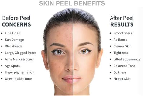 Chemical Peel Staten Island, Regenerate & Brighten the Skin with V ...