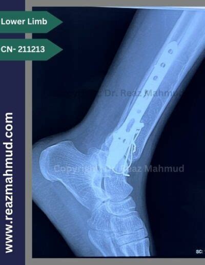 Bimalleolar Ankle Fracture | ORIF [CN-211213] - Dr. Reaz Mahmud