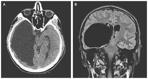 Brain cyst: causes, symptoms and diagnosis