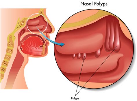 Nasal Polyps - Causes, Symptoms, Home Remedies,Treatment