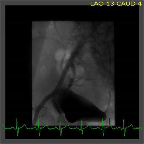 Stent Selection for Iliac Intervention - Vascular Medicine