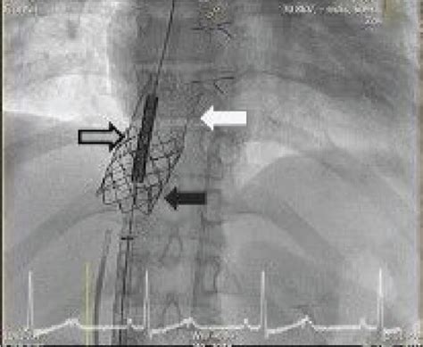 A second bare stent was then applied over the overlapping section of ...