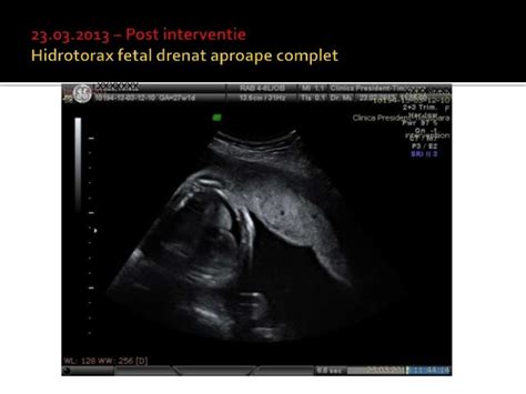 Hidrotorax fetal shunt pleuro amniotic