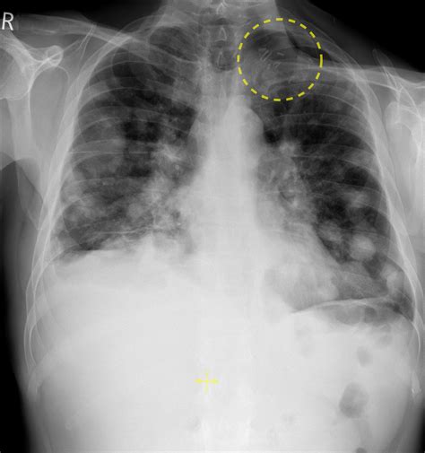 Lung metastases from head and neck cancer - Radiology at St. Vincent's ...