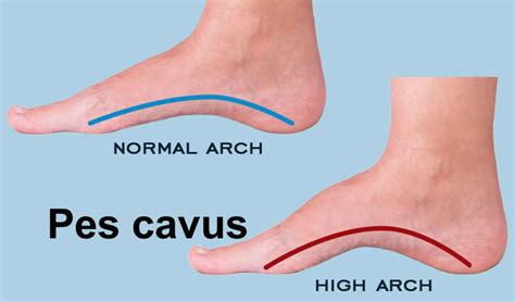 Pes cavus foot definition, causes, symptoms, diagnosis & treatment