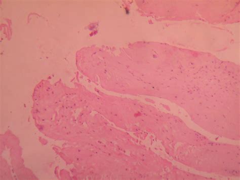 MENISCAL CYST – Histopathology.guru