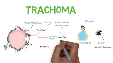 Trachoma - a devastating infectious eye disease - YouTube