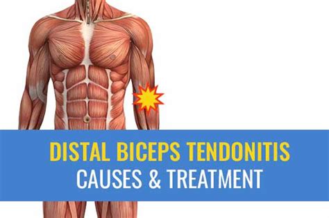 Distal biceps tendonitis – causes and treatment