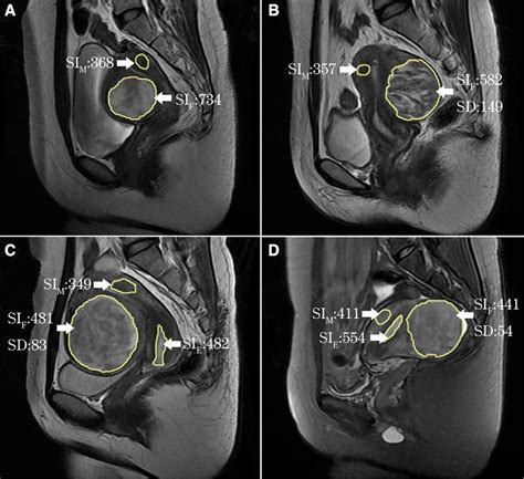 Frontiers Ultrasound-guided HIFU For Uterine Fibroids Of, 50% OFF