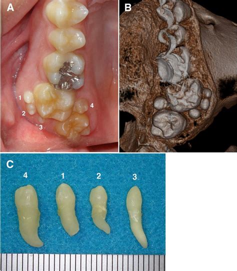 What is Hyperdontia: Understanding the Rare Dental Condition ...