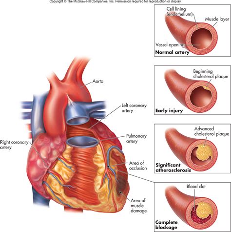 atherosclerosis - Dictionary