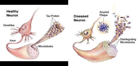 1: Neurofibrillary tangles and senile plaques in a healthy neuron ...