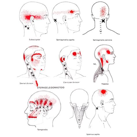 Headaches and Neck Pain or Cervicogenic Headache